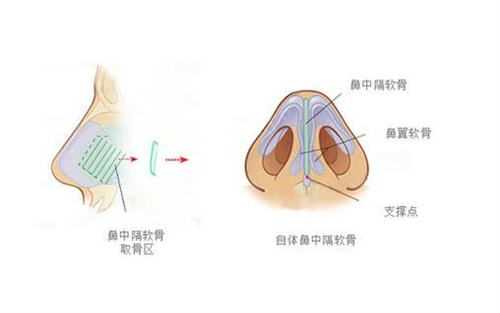 隆鼻结构示意图