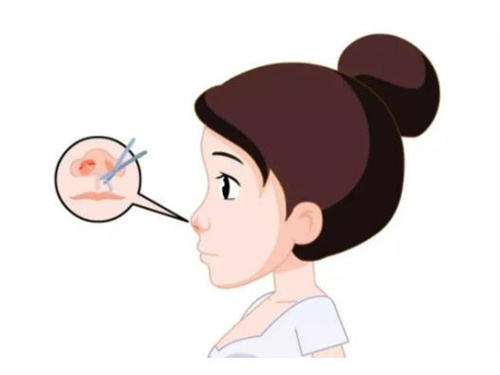 隆鼻思考示意图