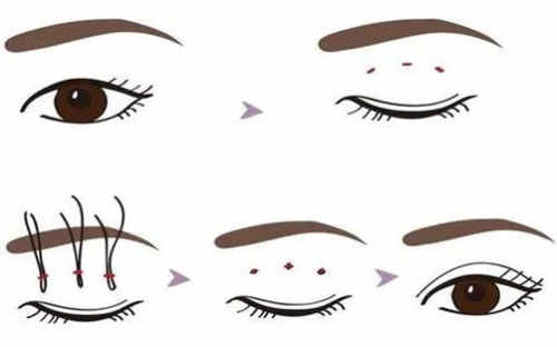 双眼皮操作过程图