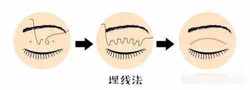 双眼皮手术方式