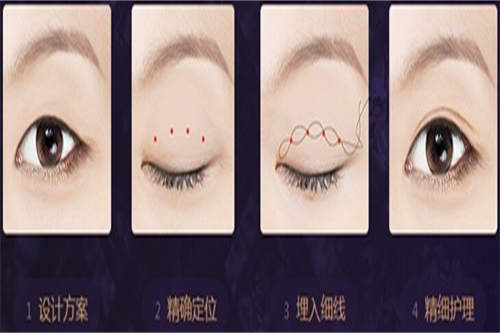 埋线双眼皮演示图