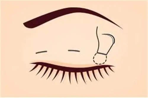 双眼皮缝合图