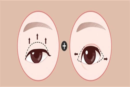 双眼皮示意图