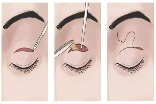 双眼皮手术过程图