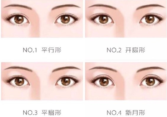 双眼皮整形示意图 双眼皮整形示意图