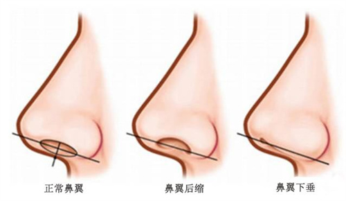 鼻翼整形示意图