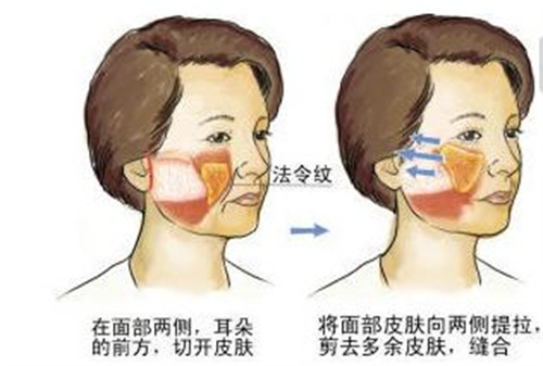 面部松弛示意图 面部松弛示意图