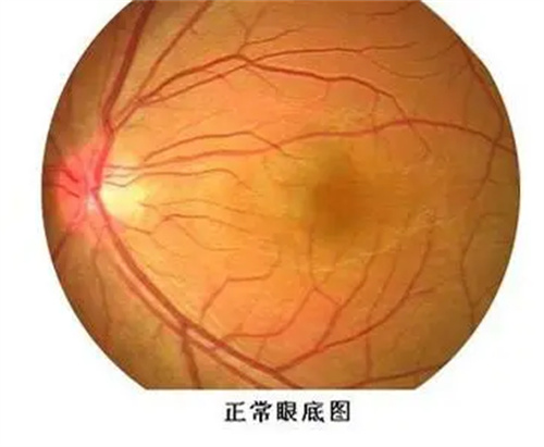 正常眼底图
