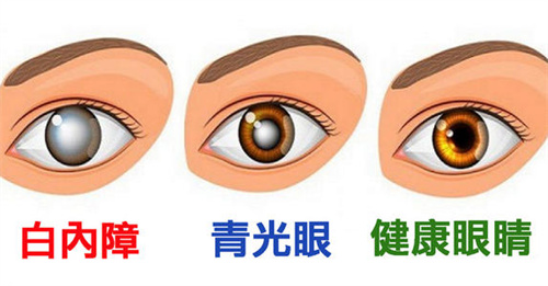 白内障卡通图示意图