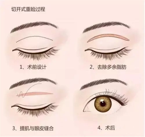 重睑整形示意图