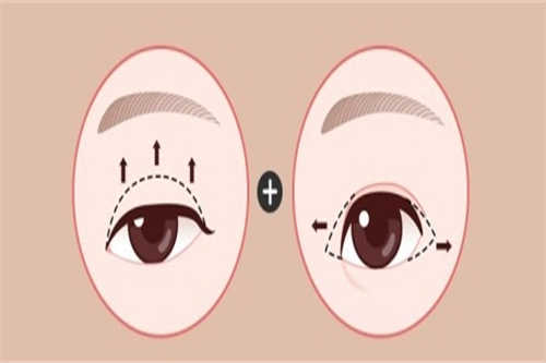 双眼皮示意图 双眼皮示意图