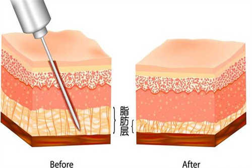 吸脂示意图 吸脂示意图