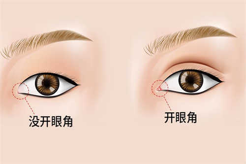 开眼角对比效果图