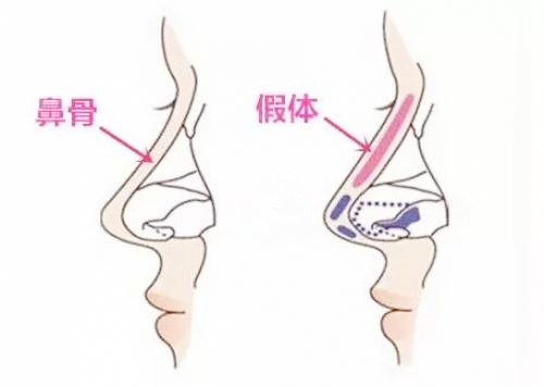 隆鼻假体图示
