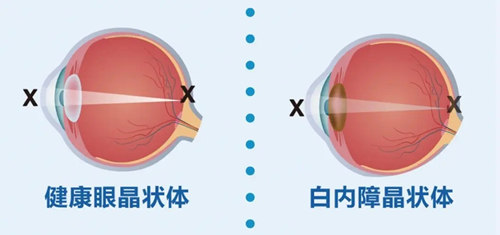 白内障晶状体