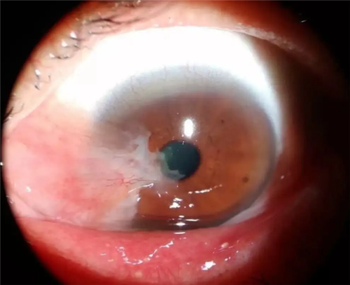 眼角胬肉图片 眼角胬肉图片