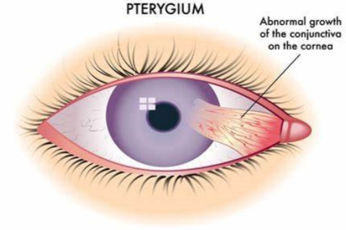 翼状胬肉高清示意图 翼状胬肉高清示意图