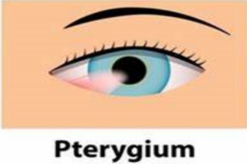 翼状胬肉眼睛 翼状胬肉眼睛