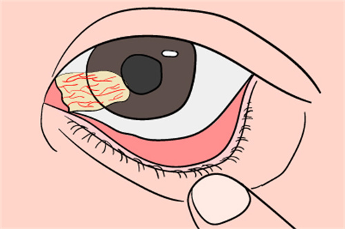翼状胬肉 翼状胬肉