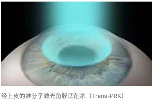 近视眼手术10