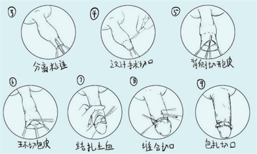割包皮手术过程