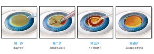 成都白内障手术哪里做的好？成都普瑞眼科、新视界眼科、小青草眼科医院三家对比分析