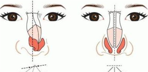 鼻梁矫正对比 鼻梁矫正对比