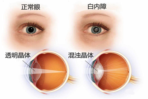 白内障与正常眼睛卡通对比图