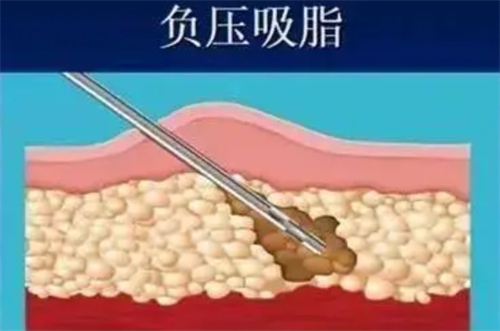 负压吸脂