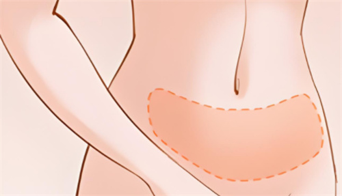 吸脂腹部区域