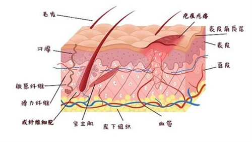 疤痕增生原理