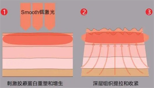 刺激胶原深层提拉