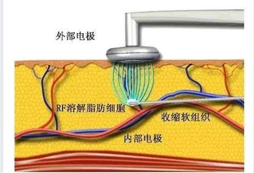 黄金微雕原理