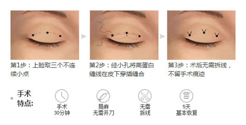 双眼皮三点术过程特点