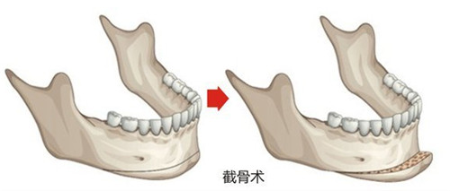 vline手术前后变化