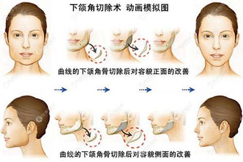 下颌角切除术动画模拟图