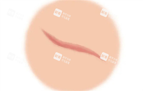 增生疤痕