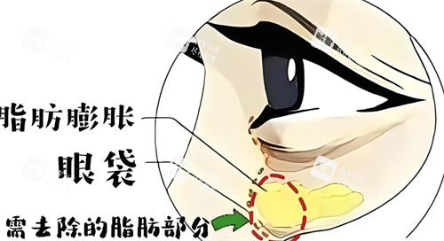 眼袋形成的原因