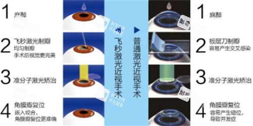 飞秒近视手术与激光近视手术的过程区别图解