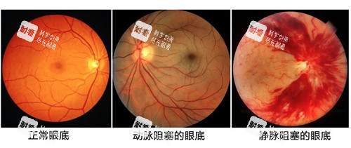 眼底检查的重要性