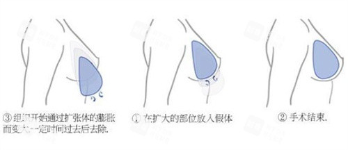 隆胸手术过程