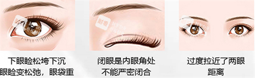 北京客莱美舍整形眼整形手术