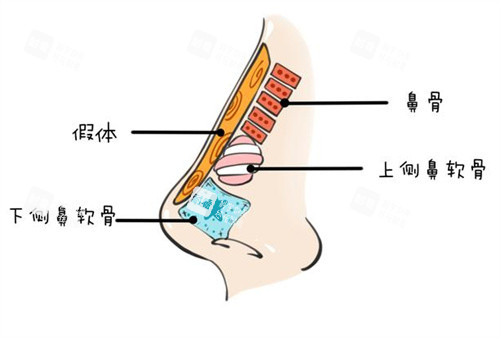 隆鼻假体图