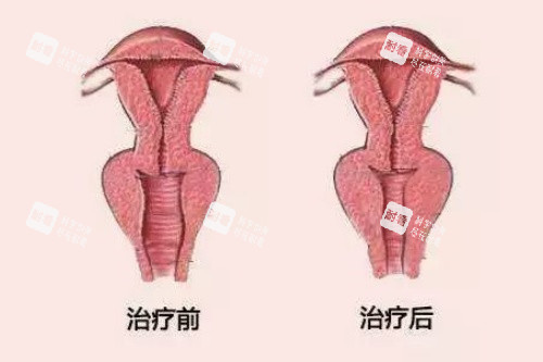 阴道紧缩卡通图