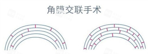 角膜交联手术