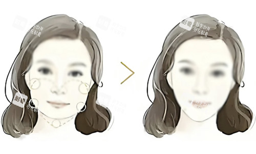 面部吸脂对比