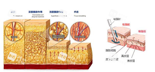 吸脂示意图
