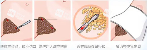 腹部吸脂过程动画图解