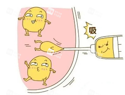 吸脂卡通示意图