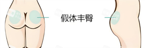 假体丰臀手术